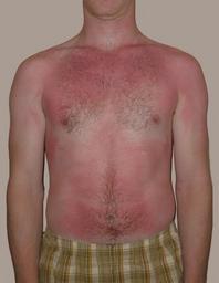 What causes sunburn?